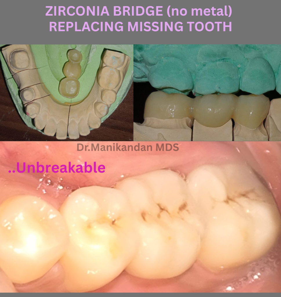 ZIRCONIA BRIDGE (NO METAL) (5)