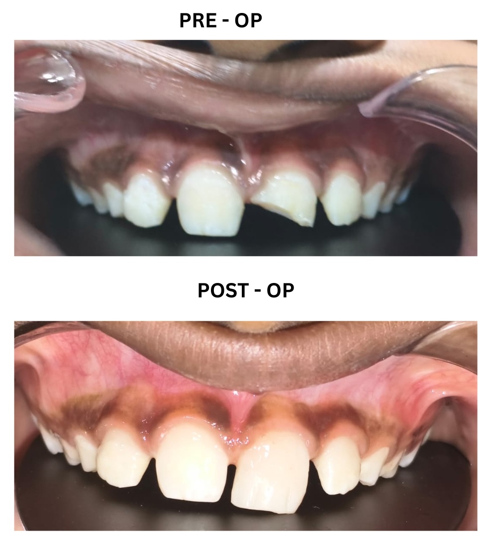 children dentistry Coimbatore-tooth town dental clinic Lakshmi Mills